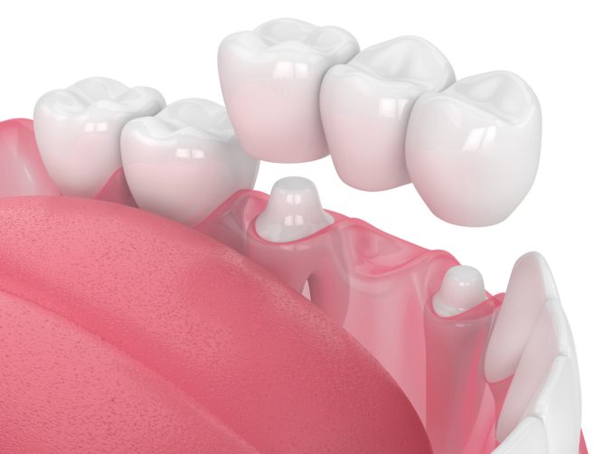 A 3D illustration of a dental bridge being placed in a patient's mouth