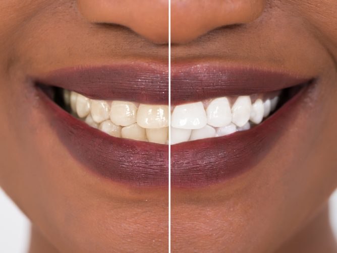 A before and after image of a woman with dirty teeth and whitened teeth