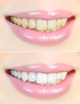 Teeth Whitening Peoria IL