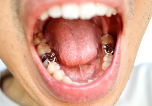 A man displays his fillings. River City Family Dentistry places Dental Fillings in East Peoria IL.