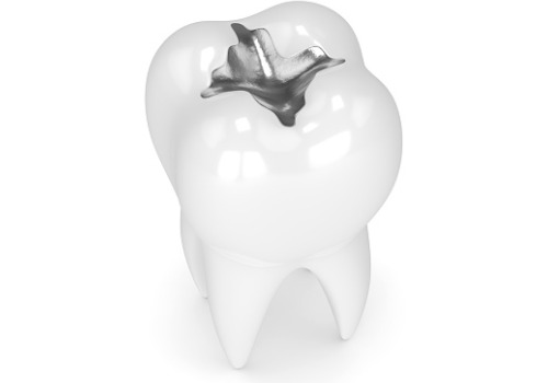 A model of a filled tooth is seen. River City Family Dentistry offers Dental Fillings in Dunlap IL.