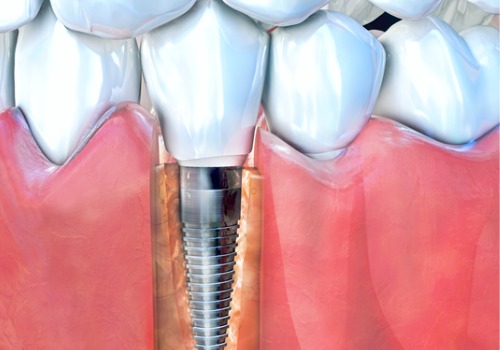An illustration of an implanted tooth is seen. River City Family Dentistry offers implants and restoration in Dunlap IL.