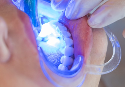 A teeth whitening procedure is seen. River City Family Dentistry offers teeth whitening.
